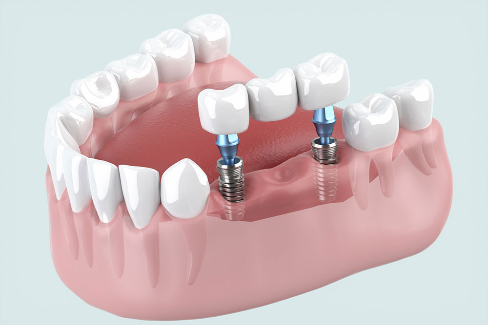 インプラントとは