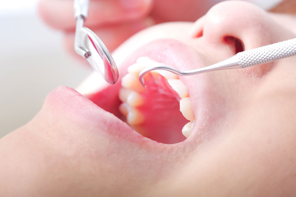 口腔外科（親知らず）について